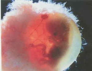 试管婴儿的胚胎停育与哪些因素有关？