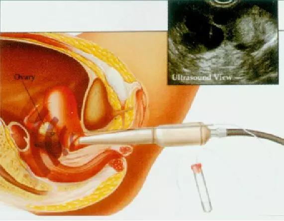 患有子宫肌瘤该怎么办？会不会影响备孕？